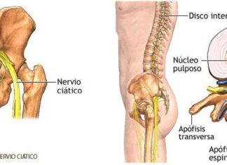 CIÁTICA ¿qué es y cómo tratarla?