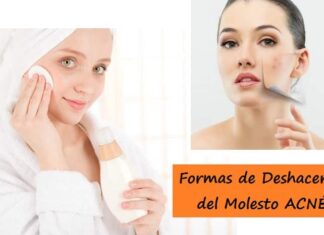 Formas de Deshacerse del Molesto ACNÉ Consejos para Tratar y Prevenir el Acné