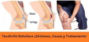 Tratamiento de la Tendinitis Rotuliana