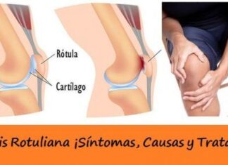 Tendinitis Rotuliana ¡Síntomas, Causas y Tratamiento! Tratamiento de la Tendinitis Rotuliana