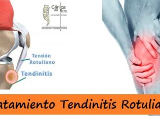 Tendinitis Rotuliana ¿Qué es, Cómo Prevenirla y TRATAMIENTO? Tratamiento de la Tendinitis Rotuliana