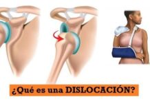 ¿Qué es una DISLOCACIÓN? ¿Que es una Dislocación o Luxación?