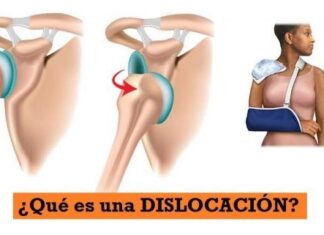 ¿Qué es una DISLOCACIÓN? ¿Que es una Dislocación o Luxación?
