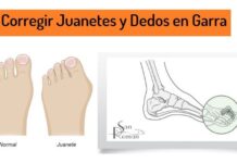 Corregir JUANETES y «DEDOS en GARRA» ¿es posible? Corregir Juanetes y Dedos en Garra