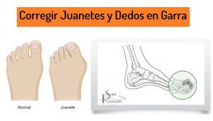 Corregir Juanetes y Dedos en Garra