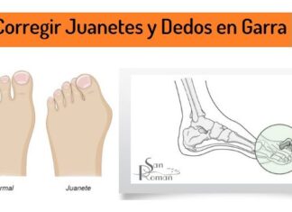 Corregir JUANETES y «DEDOS en GARRA» ¿es posible? Corregir Juanetes y Dedos en Garra