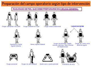 ¿Cómo RASURAR a un PACIENTE antes de una intervención quirúrgica? que zonas rasurar antes de una operacion