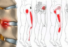 3 TRATAMIENTOS para el Dolor Ciático en Pierna Derecha