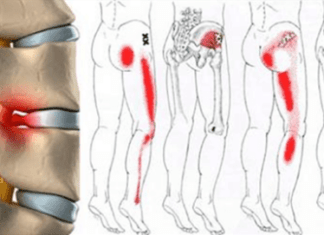 3 TRATAMIENTOS para el Dolor Ciático en Pierna Derecha