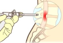 Ejercicios para tratar CIÁTICA POR HERNIA DISCAL