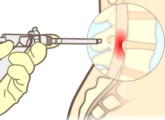 Ejercicios para tratar CIÁTICA POR HERNIA DISCAL