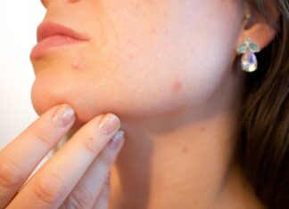 6 tips para mejorar la rosácea de la cara mejorar la rosacea de la cara