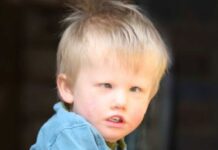 5 ENFERMEDADES RARAS que están esparcidas por el mundo