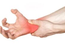 Síndrome Túnel Carpiano ¿Debo operarme?