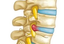 Ciática por HERNIA DISCAL