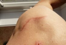 La importancia de tratar las cicatrices La importancia de tratar las cicatrices