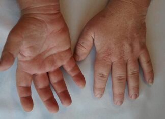 Fisioterapia para enfermedades raras: ACROMEGALIA