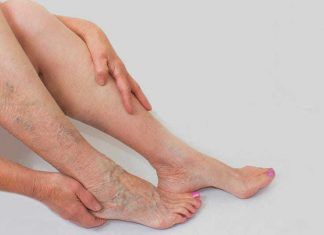 Consejos y trucos para combatir las várices Como combatir las varices