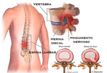 Hernia Discal. Ejercicios para aliviar el dolor. Que es una hernia discal