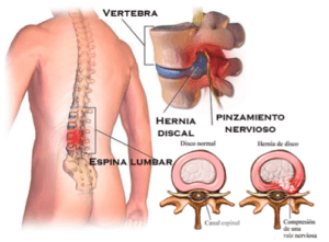 Que es una hernia discal