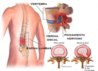 Hernia Discal. Ejercicios para aliviar el dolor. Que es una hernia discal