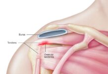 Tendinitis de hombro y cómo aliviar el dolor