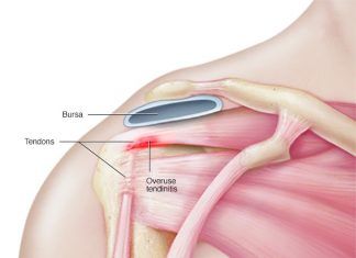 Tendinitis de hombro y cómo aliviar el dolor