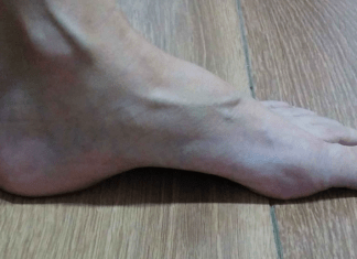 Pie cavo, cómo detectarlo y tratarlo