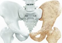Tratamiento fisioterapéutico de osteoporosis