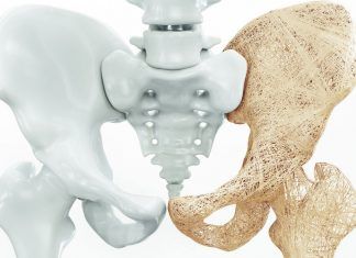 Tratamiento fisioterapéutico de osteoporosis
