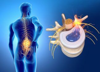 Fisioterapia para hernias de disco