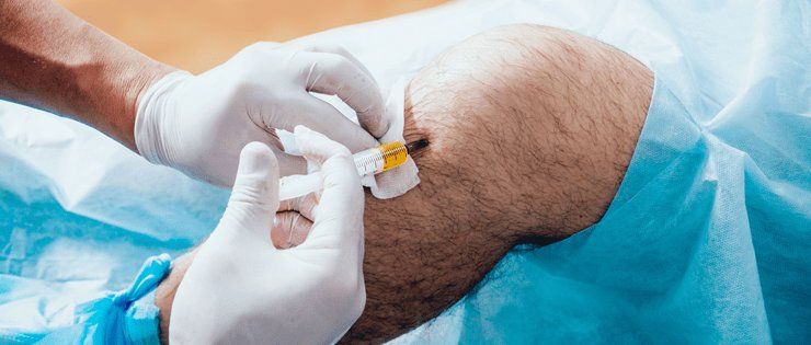 Cómo se practica el tratamiento PRP en rodillas