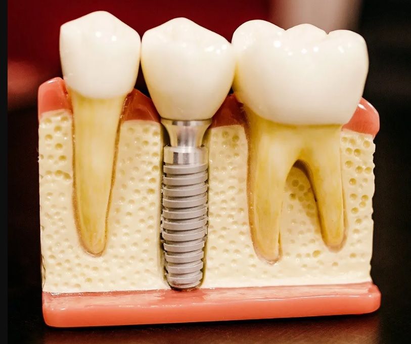 protesis dental madrid