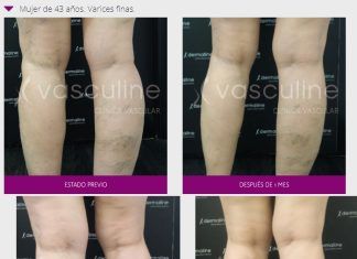 Las varices son un peligro real para nuestro cuerpo varices piernas