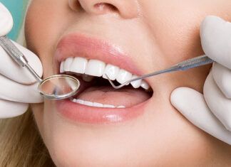 ¿Qué son las carillas dentales y por qué están revolucionando la odontología estética? carillas dentales